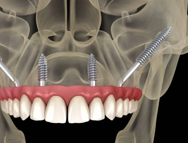 Protocolo sobre implantes