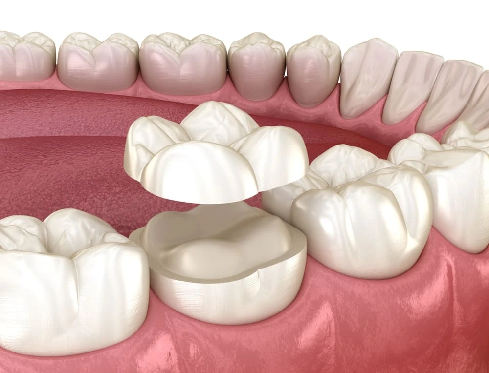 Restauração dentária